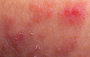 Piel inflamada y roja.